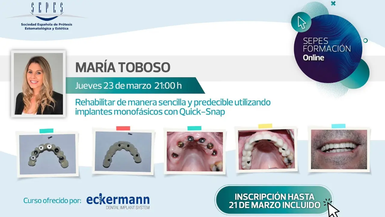 Rehabilitar de manera sencilla y predecible utilizando implantes monofásicos con Quick-Snap