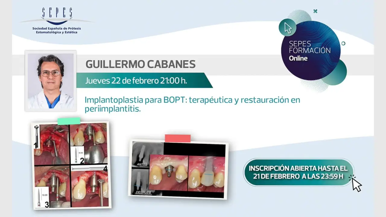 Implantoplastia para BOPT: terapéutica y restauración en periimplantitis.