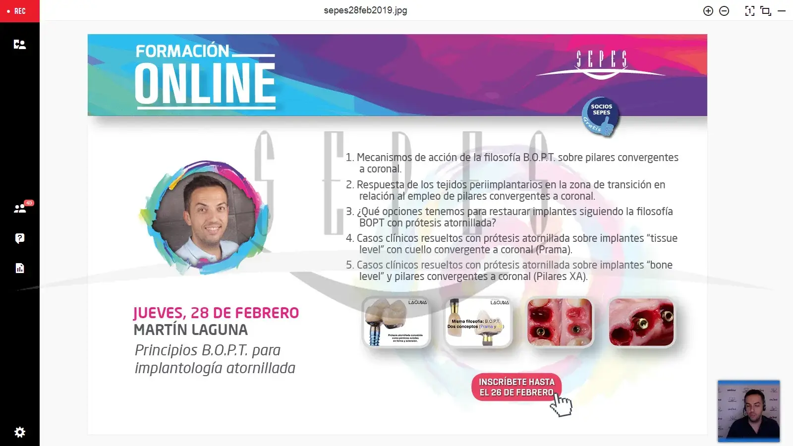 Principios B.O.P.T. para implantología atornillada.