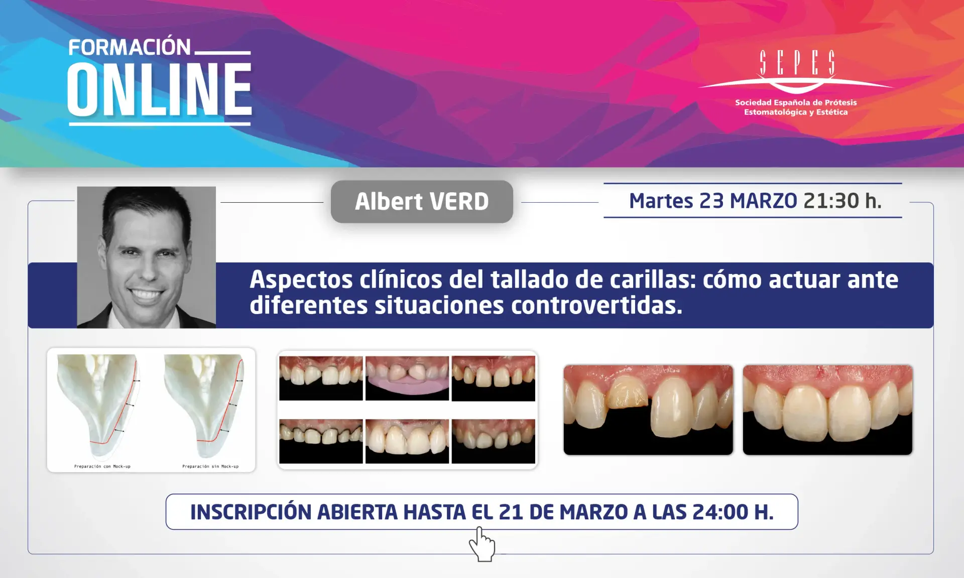 Aspectos clínicos del tallado de carillas: cómo actuar ante diferentes situaciones controvertidas.
