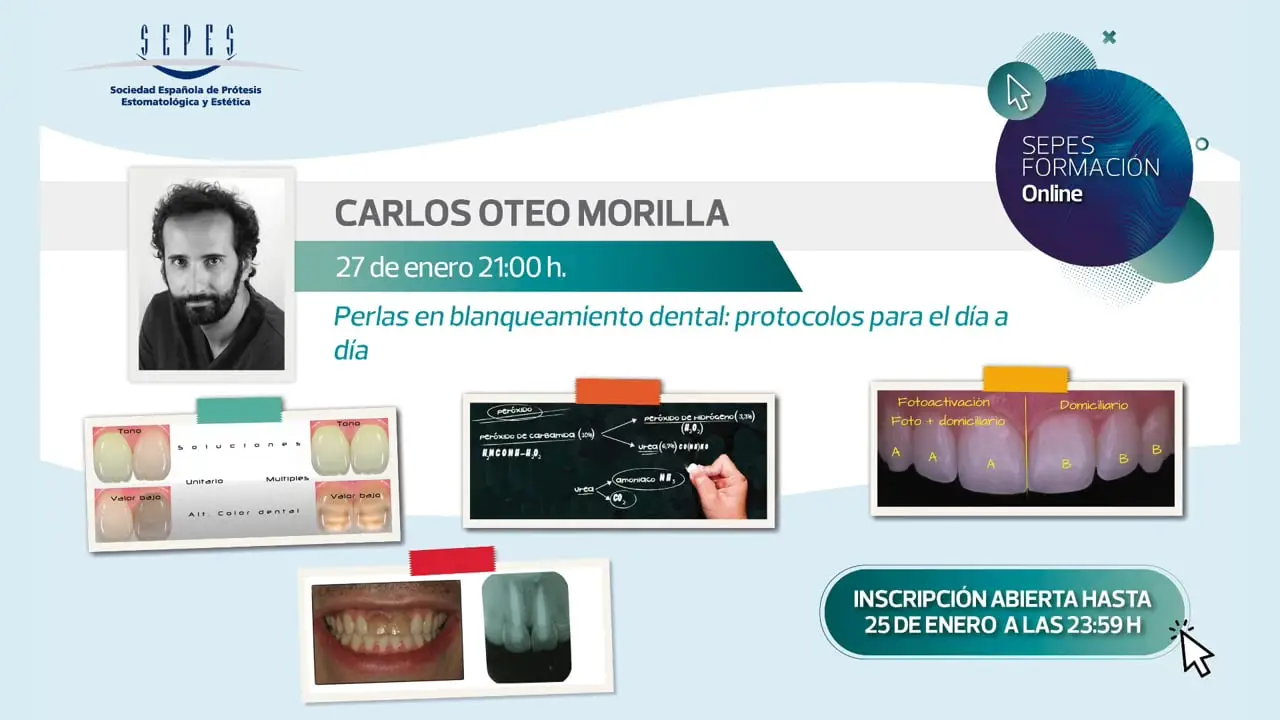 Perlas en blanqueamiento dental: protocolos para el día a día