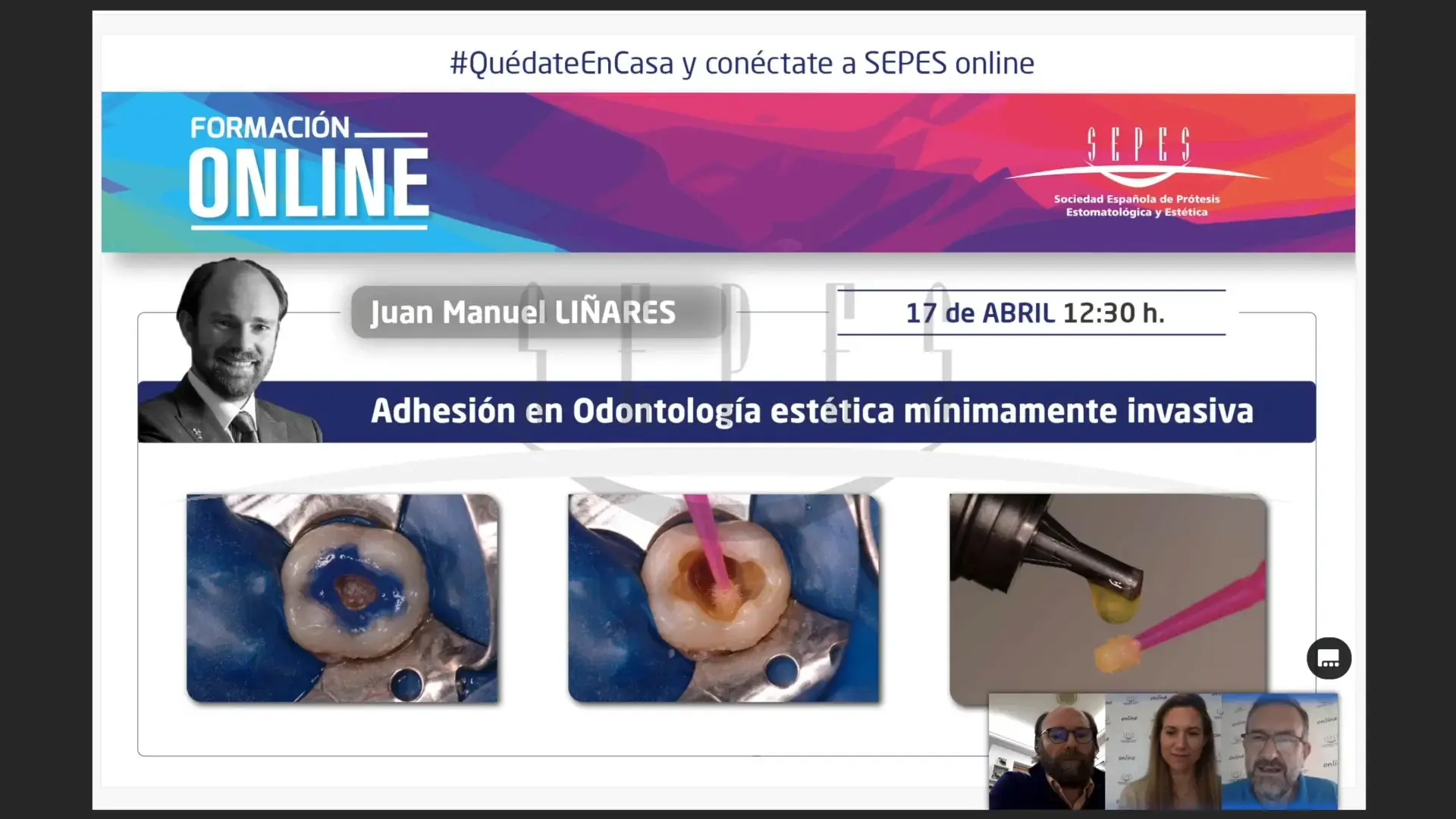 Adhesión en Odontología estética mínimamente invasiva.
