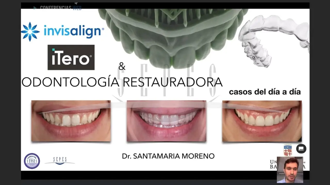 Invasilign y Odontología restauradora. Casos del día a día.